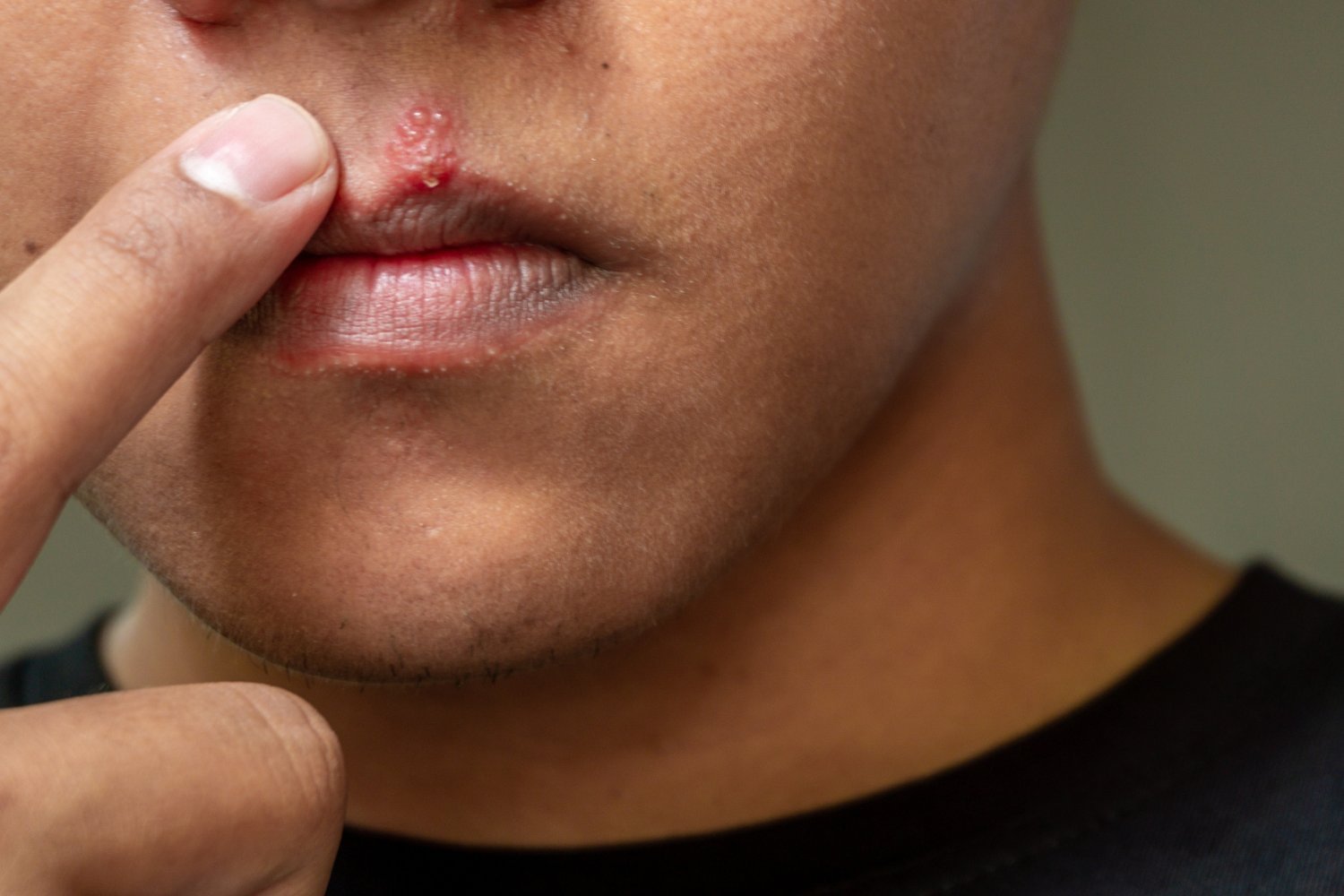Cold Sore